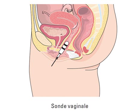 Sonde Vaginale