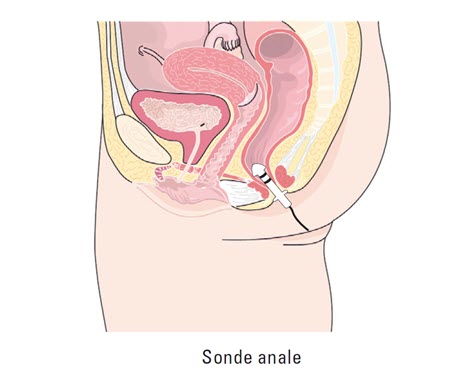 Sonde Anale